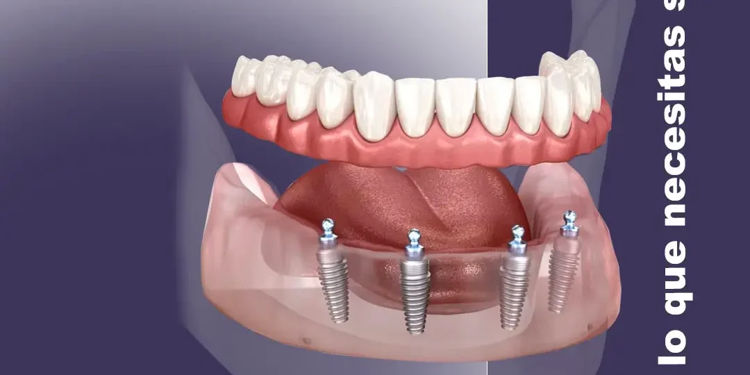 Prótesis sobre 4 implantes