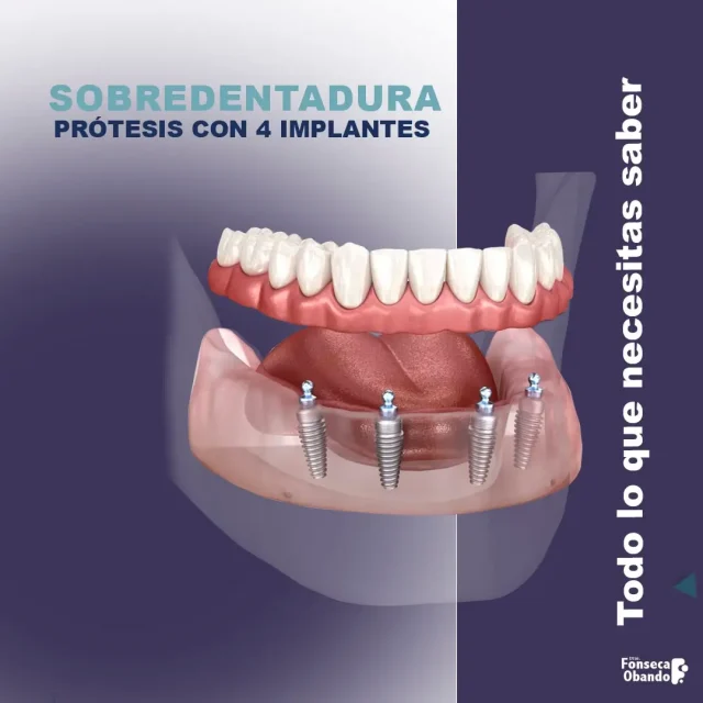 Prótesis sobre 4 implantes