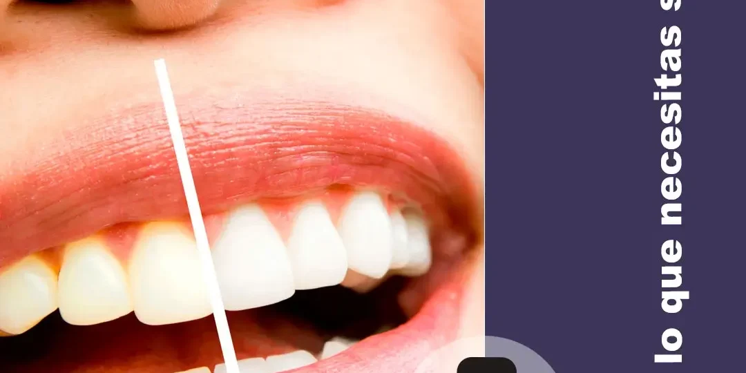 Blanqueamiento dental