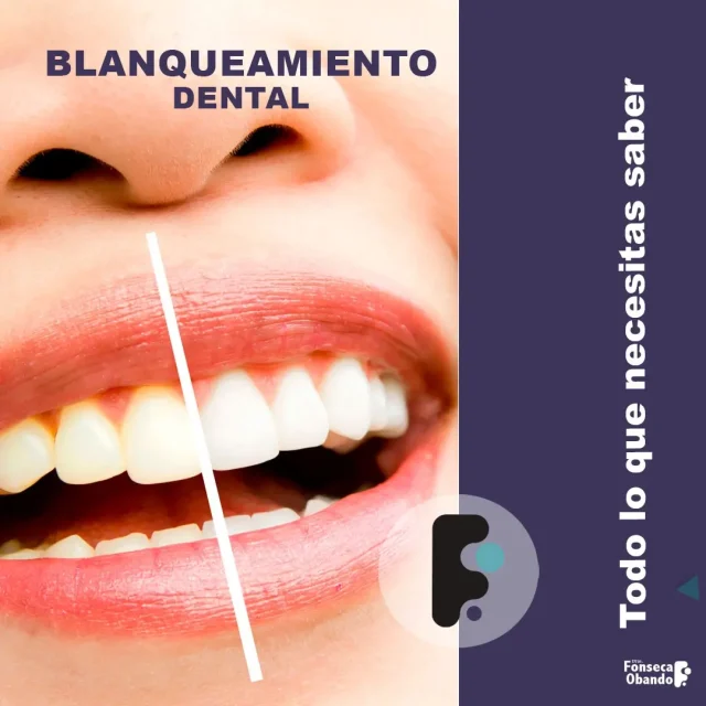 Blanqueamiento dental