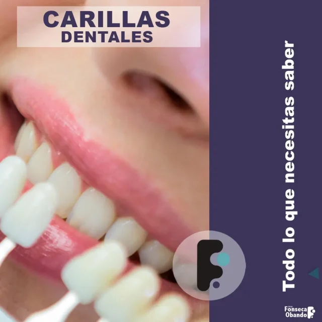 Carillas dentales
