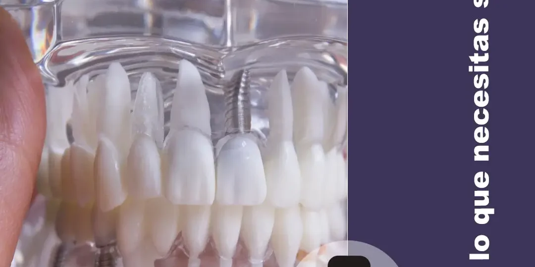 implante-dental