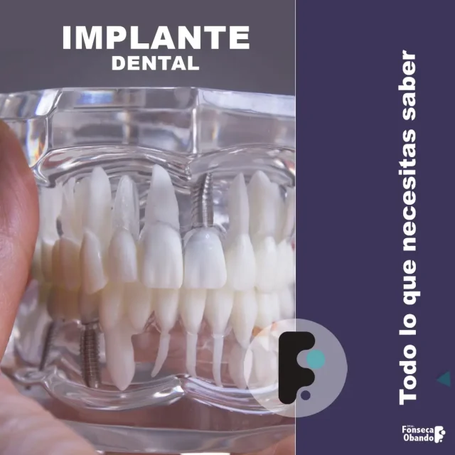implante-dental