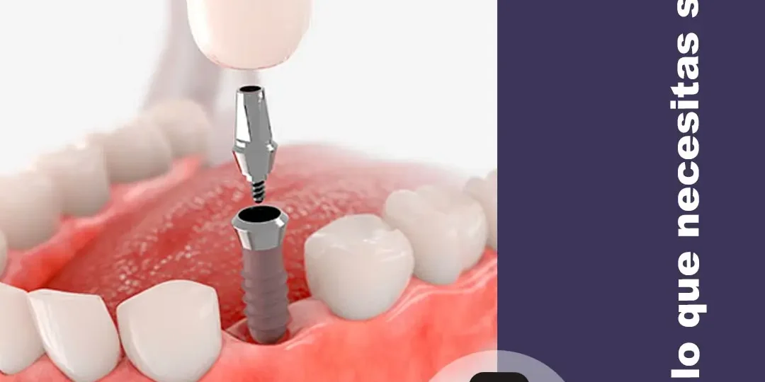 Implantes de carga inmediata