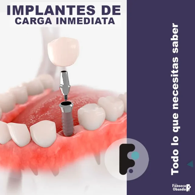 Implantes de carga inmediata