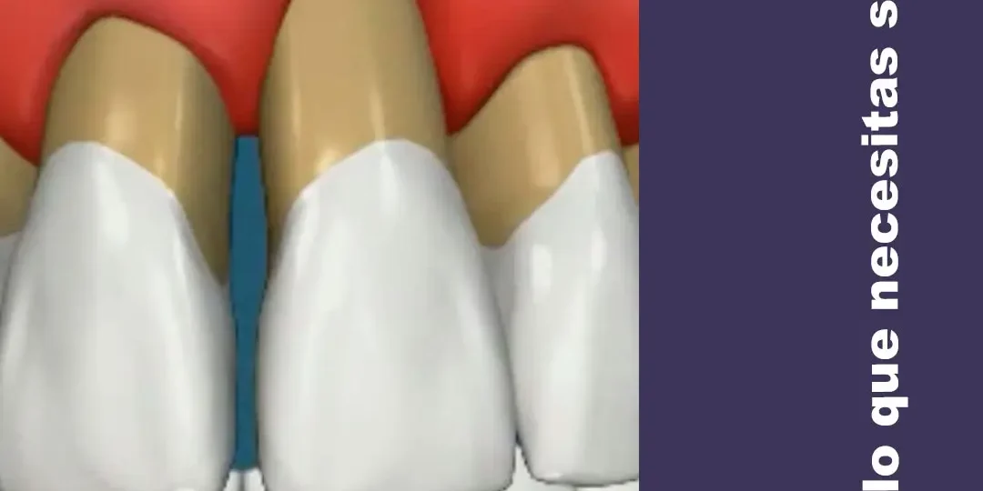 Periodoncia o Piorrea