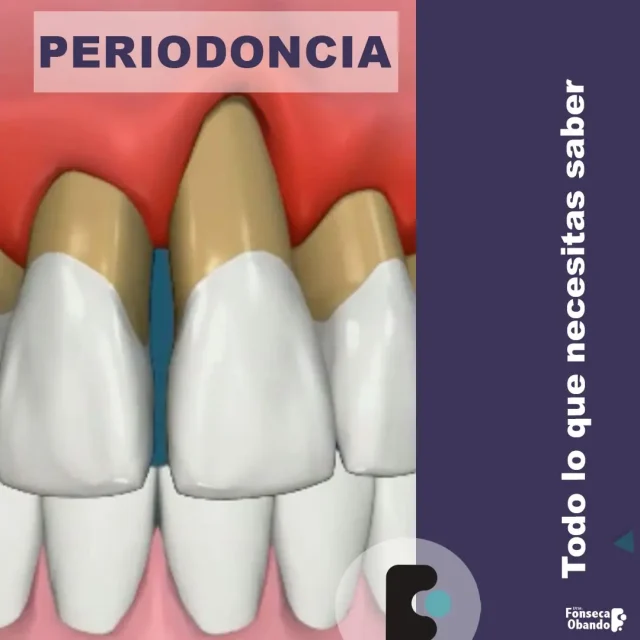 Periodoncia o Piorrea
