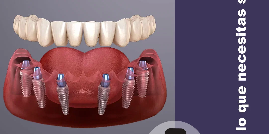 Prótesis sobre 4 implantes