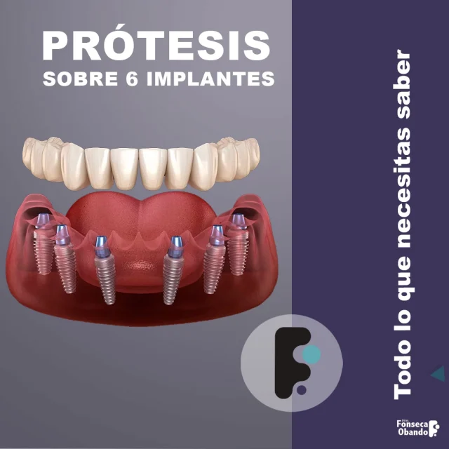 Prótesis sobre 4 implantes