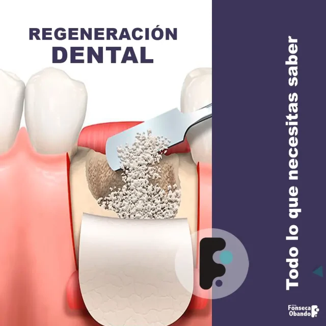 Regeneración Ósea