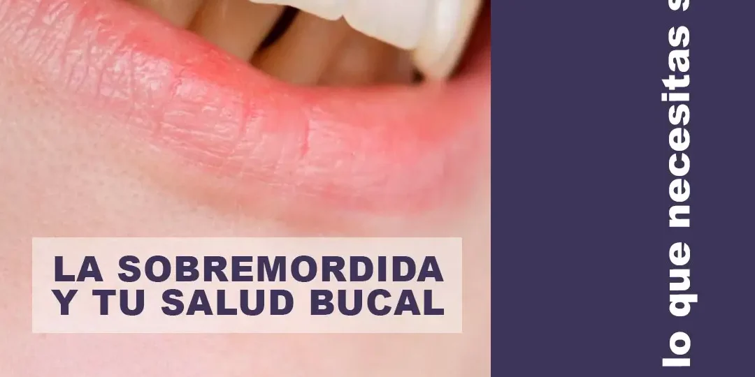 Cómo afecta la sobremordida a tu salud bucal