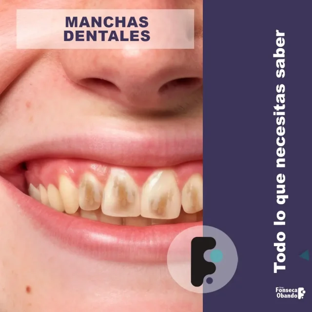 Manchas dentales