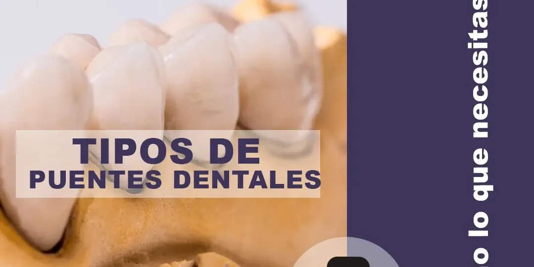 Tipos de puentes dentales