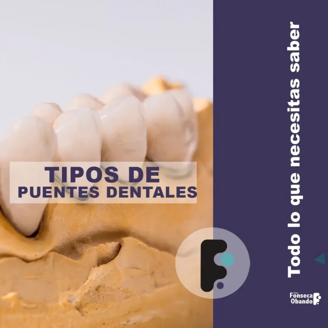 Tipos de puentes dentales