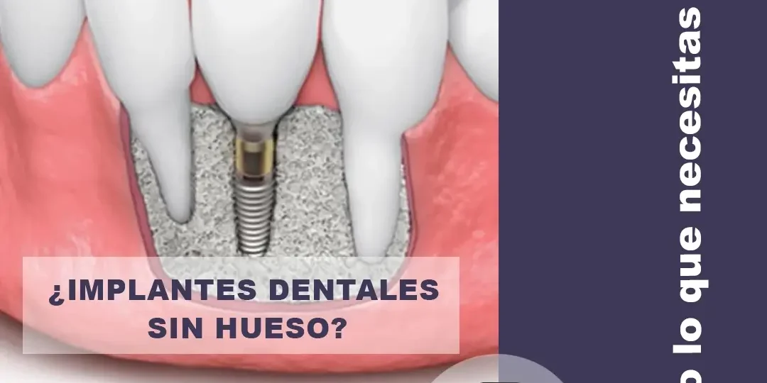 ¿Qué pasa si no tengo hueso suficiente para implantes dentales?