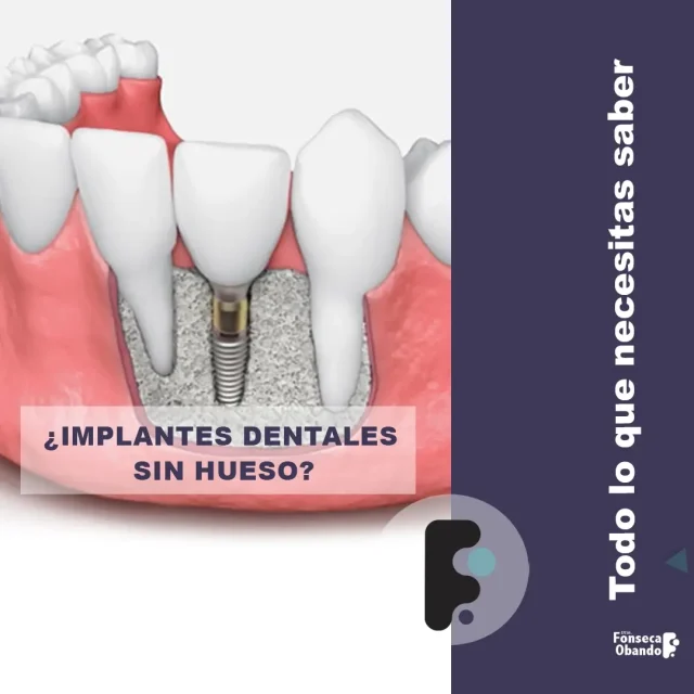 ¿Qué pasa si no tengo hueso suficiente para implantes dentales?