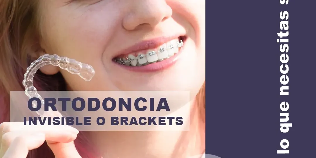 Ortodoncia Invisible o Brackets