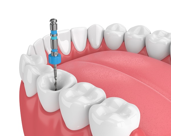Endodoncia en General Ricardos Endodoncia en General Ricardos
