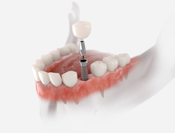 Implantes Dentales General Ricardos Implantes Dentales General Ricardos