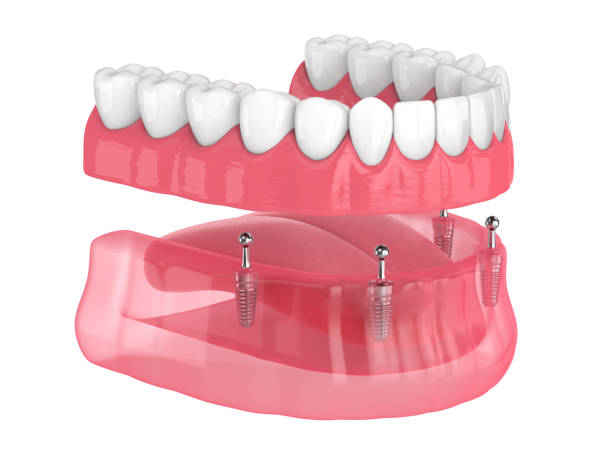 Prótesis dentales en General Ricardos