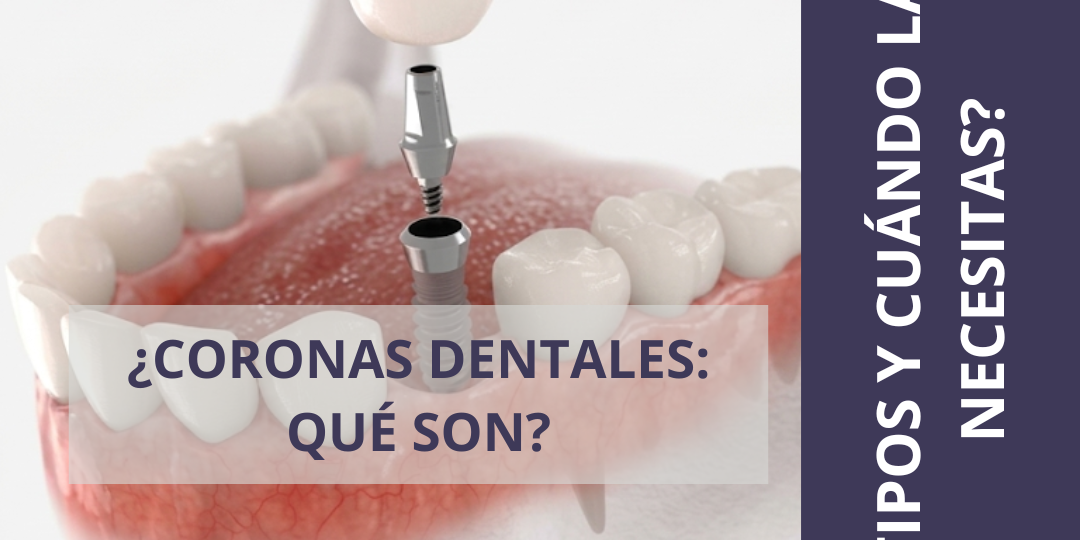 ¿CORONAS DENTALES QUÉ SON