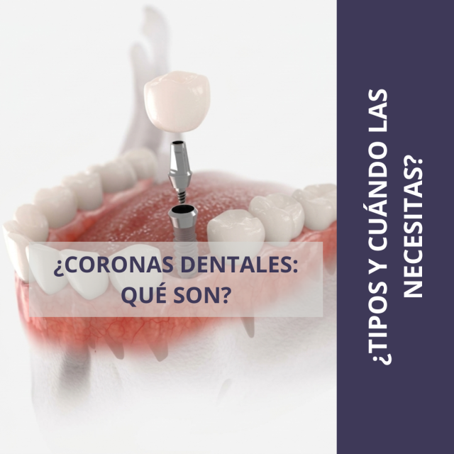 ¿CORONAS DENTALES QUÉ SON